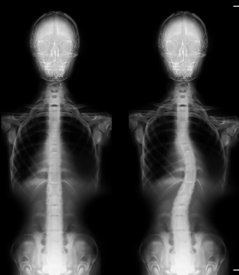scoliosis Wesley Chapel FL
